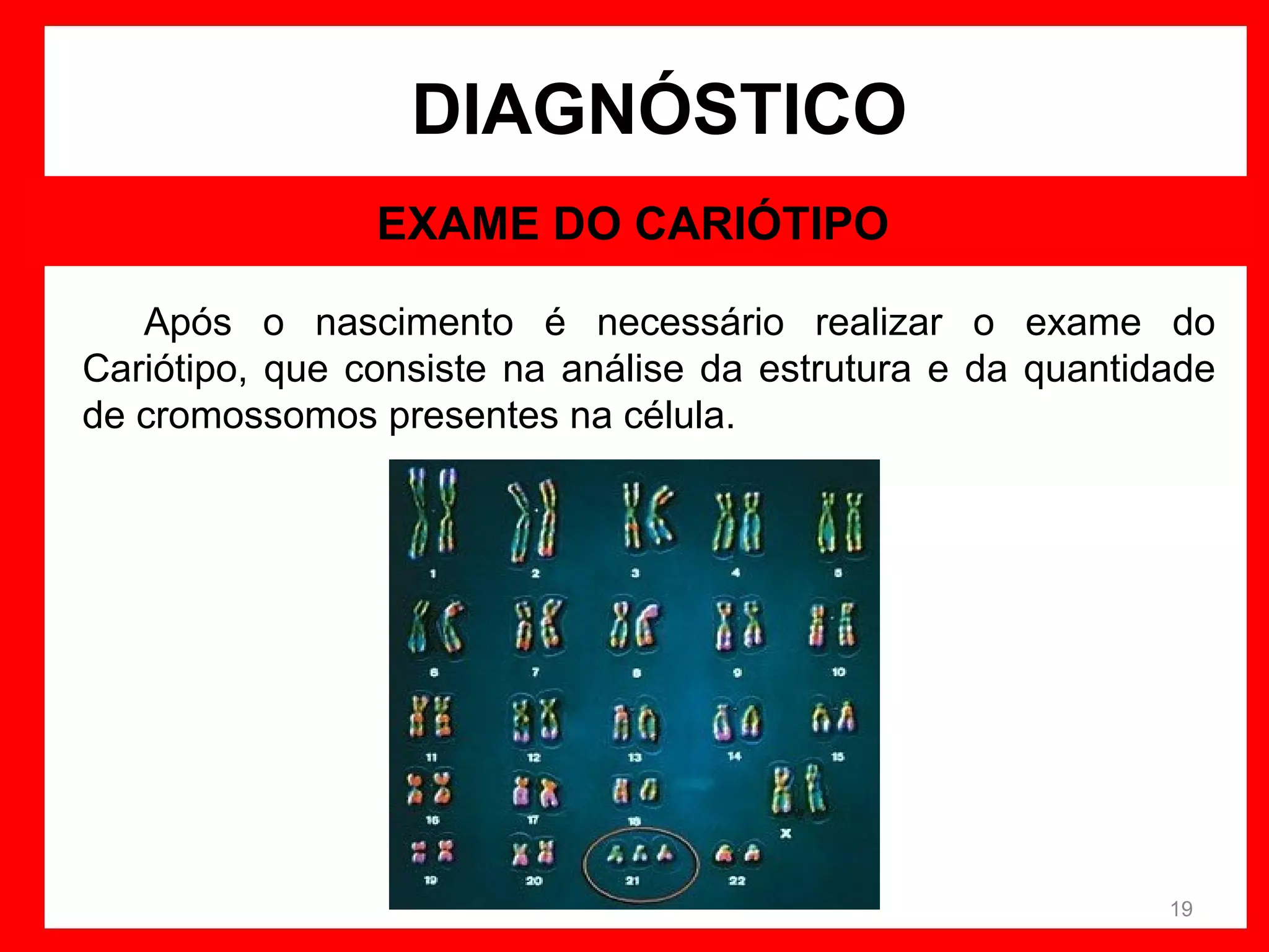 DIAGNÓSTICO
EXAME DO CARIÓTIPO
Após o nascimento é necessário realizar o exame do
Cariótipo, que consiste na análise da estrutura e da quantidade
de cromossomos presentes na célula.

19

 