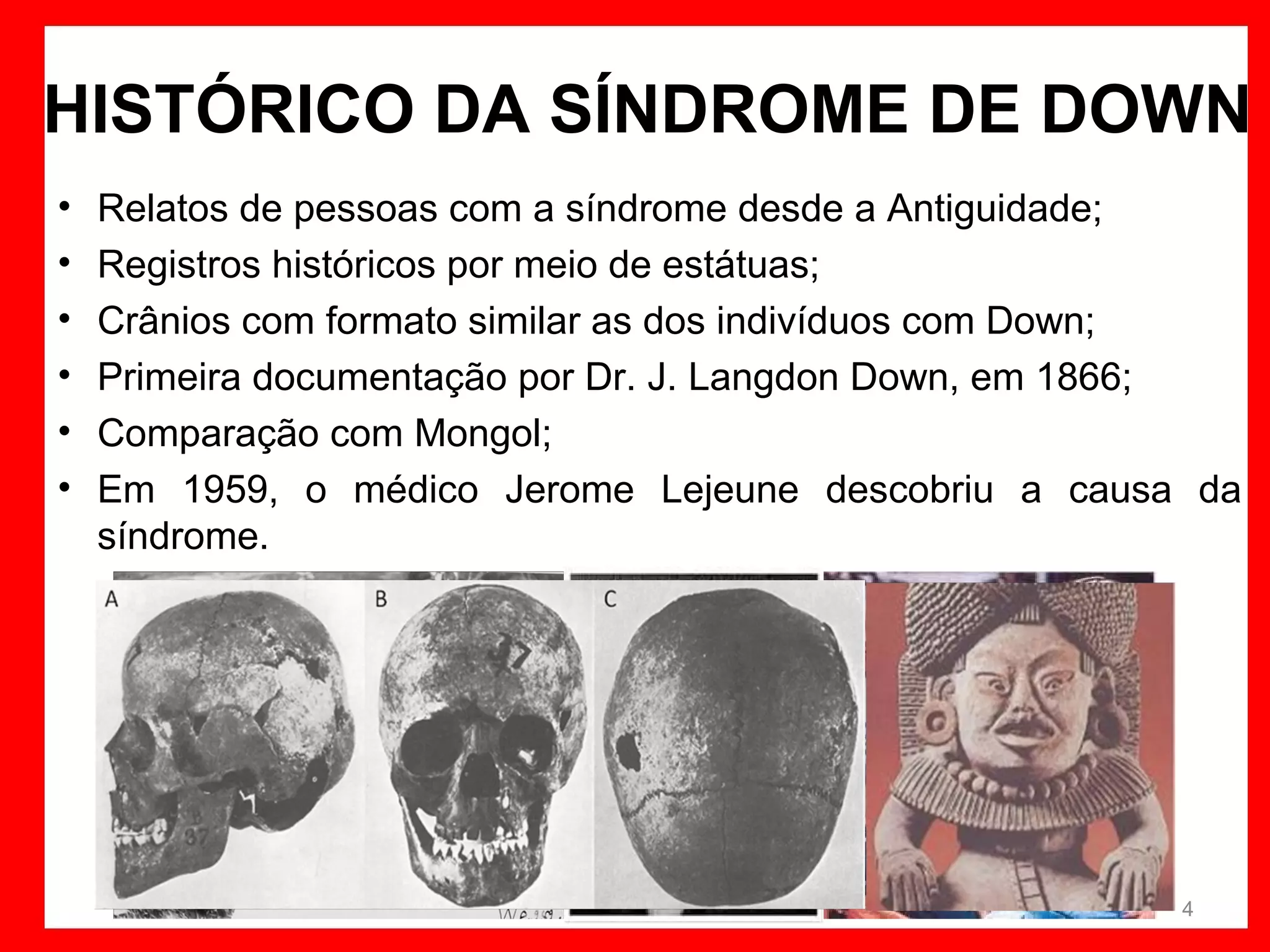 HISTÓRICO DA SÍNDROME DE DOWN
•
•
•
•
•
•

Relatos de pessoas com a síndrome desde a Antiguidade;
Registros históricos por meio de estátuas;
Crânios com formato similar as dos indivíduos com Down;
Primeira documentação por Dr. J. Langdon Down, em 1866;
Comparação com Mongol;
Em 1959, o médico Jerome Lejeune descobriu a causa da
síndrome.

4

 