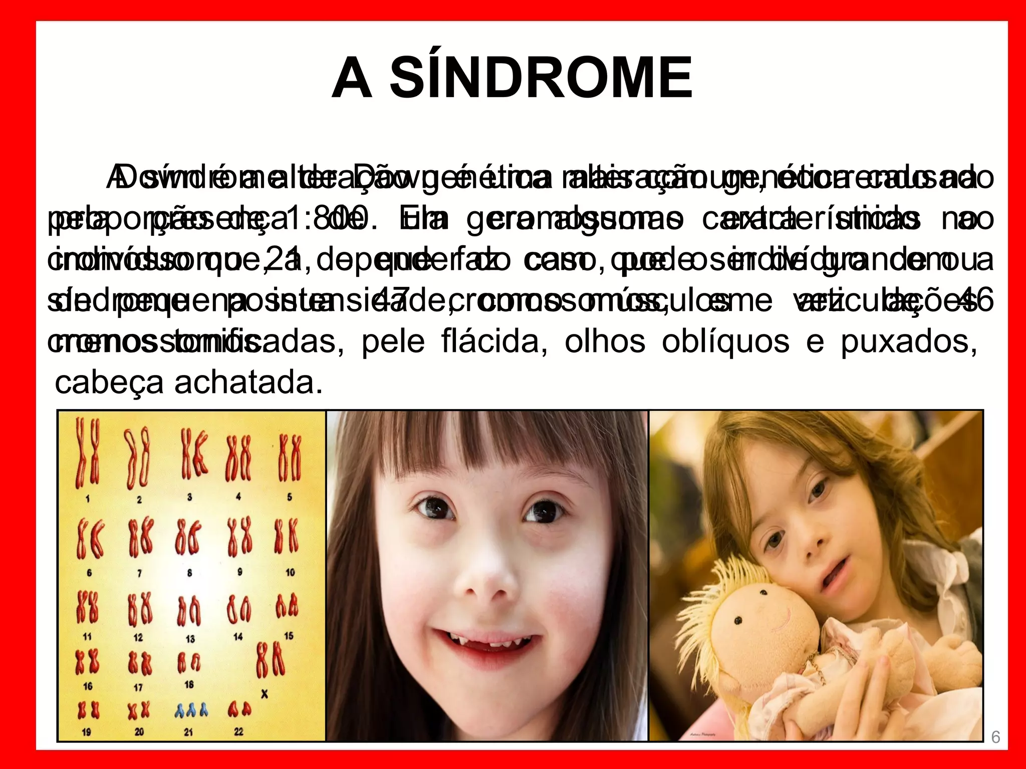 A SÍNDROME
A síndrome de Down é uma mais comum, ocorrendo na
Down é a alteração genética alteração genética causado
pela presença1:800. Ela gera algumas características no
de um cromossomo extra unido ao
proporção de
cromossomo 21, dependerfaz com que oser de grande oua
indivíduo que, a o que do caso, pode indivíduo com
síndrome possua 47 cromossomos, eme vez de 46
de pequena intensidade, como músculos
articulações
cromossomos.
menos tonificadas, pele flácida, olhos oblíquos e puxados,
cabeça achatada.

6

 