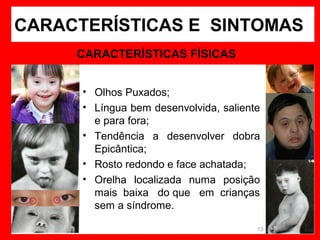 CARACTERÍSTICAS E SINTOMAS
CARACTERÍSTICAS FÍSICAS
• Olhos Puxados;
• Língua bem desenvolvida, saliente
e para fora;
• Tendência a desenvolver dobra
Epicântica;
• Rosto redondo e face achatada;
• Orelha localizada numa posição
mais baixa do que em crianças
sem a síndrome.
13

 