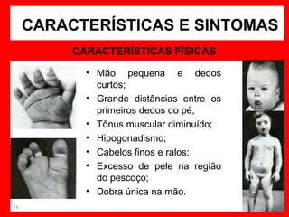 CARACTERÍSTICAS E SINTOMAS
CARACTERÍSTICAS FÍSICAS
• Mão pequena e dedos
curtos;
• Grande distâncias entre os
primeiros dedos do pé;
• Tônus muscular diminuído;
• Hipogonadismo;
• Cabelos finos e ralos;
• Excesso de pele na região
do pescoço;
• Dobra única na mão.
14

 