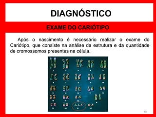 DIAGNÓSTICO
EXAME DO CARIÓTIPO
Após o nascimento é necessário realizar o exame do
Cariótipo, que consiste na análise da estrutura e da quantidade
de cromossomos presentes na célula.

19

 