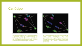 Cariótipo
A: Computação gráfica demonstrando
a meiose com os cromossomos na
linha equatorial. Observe a existência
de uma anormalidade do fuso em um
dos cromossomos do par superior.
B: Computação gráfica da expressão de
uma não disjunção do par
cromossômico superior com ruptura do
fuso acarretando uma célula trissomica
(superior) e uma monossômica
(inferior).
 
