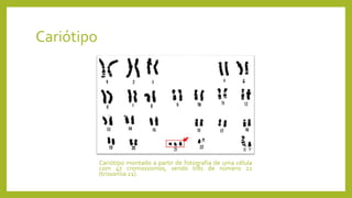 Cariótipo
Cariótipo montado a partir de fotografia de uma célula
com 47 cromossomos, sendo três de número 21
(trissomia 21).
 