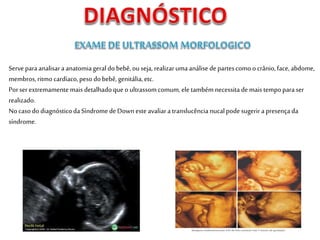 Serveparaanalisara anatomiageral do bebê,ouseja, realizarumaanálisedepartescomo ocrânio,face,abdome,
membros,ritmo cardíaco,peso dobebê, genitália, etc.
Porser extremamentemais detalhadoque o ultrassomcomum, ele tambémnecessitademais tempoparaser
realizado.
Nocasodo diagnósticodaSíndromedeDownesteavaliaratranslucêncianucalpodesugerir apresençada
síndrome.
 