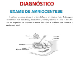 É realizado através da retirada de amostra do líquido amniótico de dentro do útero para
ser examinado num laboratório, para determinar possíveis problemas de saúde do bebê. No
caso do diagnostico da Síndrome de Down este exame é realizado para confirmar a
translucência nucal.
 