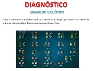 Após o nascimento é necessário realizar o exame do Cariótipo, que consiste na análise da
estrutura e da quantidade de cromossomos presentes na célula.
 