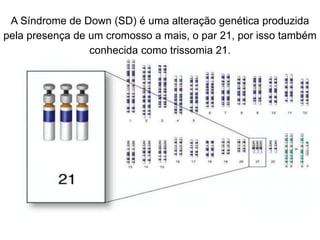 A Síndrome de Down (SD) é uma alteração genética produzida
pela presença de um cromosso a mais, o par 21, por isso também
conhecida como trissomia 21.
 