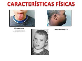 Língua grande,
protusa e sulcada
Orelhas dismórficas
 