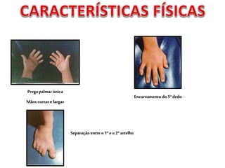 Prega palmar única
Mãos curtas e largas
Encurvamento do 5º dedo
Separaçãoentre o1º e o 2º artelho
 