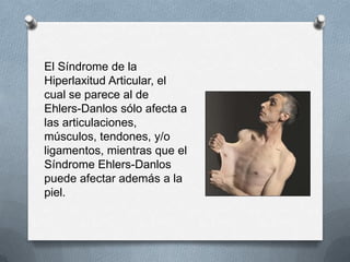 El Síndrome de la
Hiperlaxitud Articular, el
cual se parece al de
Ehlers-Danlos sólo afecta a
las articulaciones,
músculos, tendones, y/o
ligamentos, mientras que el
Síndrome Ehlers-Danlos
puede afectar además a la
piel.
 