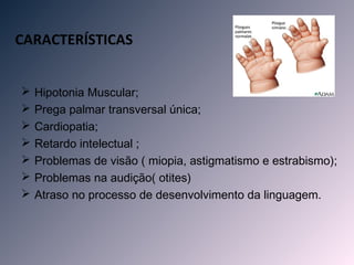 CARACTERÍSTICAS


   Hipotonia Muscular;
   Prega palmar transversal única;
   Cardiopatia;
   Retardo intelectual ;
   Problemas de visão ( miopia, astigmatismo e estrabismo);
   Problemas na audição( otites)
   Atraso no processo de desenvolvimento da linguagem.
 