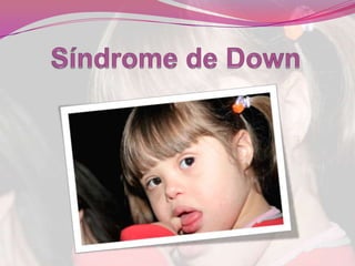 Síndrome de Down 