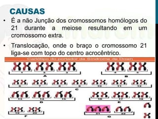 Síndrome de down ou trissomia do cromossoma 21 | PPT