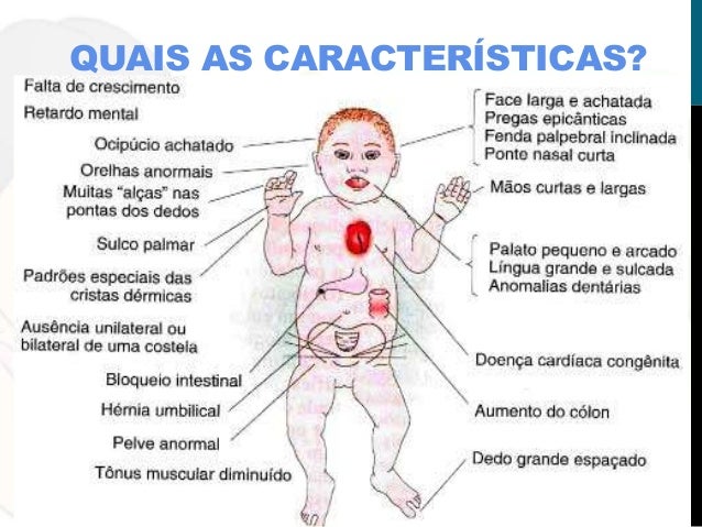 Síndrome de down ou trissomia do cromossoma 21