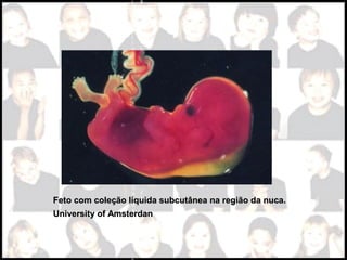 l
e
ç
ã
o
l
í
q
u
i
d
a
s
u
b
c
u
t
â
n
e
a
n
a
r
e
g
i
ã
o
d
a
n
u
c
a
.
C
o
ã
o
c
a
r
i
ó
t
i
p
o
a
n
o
r
m
a
l
-
t
r
i
s
s
o
m
i
a
2
1
,
d
e
m
o
n
s
t
r
l
e
ç
ã
o
l
í
q
u
i
d
a
s
u
b
c
u
t
â
n
e
a
n
a
r
e
g
i
ã
o
d
a
n
u
c
a
.
C
o
ã
o
c
a
r
i
ó
t
i
p
o
a
n
o
r
m
a
l
-
t
r
i
s
s
o
m
i
a
2
1
,
d
e
m
o
n
s
t
r
Feto com coleção líquida subcutânea na região da nuca.Feto com coleção líquida subcutânea na região da nuca.
University of AmsterdanUniversity of Amsterdan
 