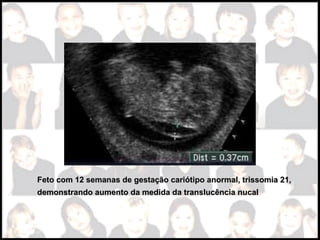 Feto com 12 semanas de gestação cariótipo anormal, trissomia 21,Feto com 12 semanas de gestação cariótipo anormal, trissomia 21,
demonstrando aumento da medida da translucência nucaldemonstrando aumento da medida da translucência nucal
 