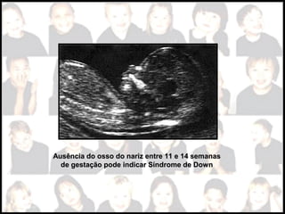 Ausência do osso do nariz entre 11 e 14 semanasAusência do osso do nariz entre 11 e 14 semanas
de gestação pode indicar Síndrome de Downde gestação pode indicar Síndrome de Down
 