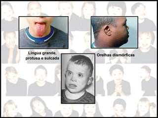 Língua grande,
protusa e sulcada 
Orelhas dismórficasOrelhas dismórficas
 