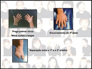 Prega palmar únicaPrega palmar única
Mãos curtas e largasMãos curtas e largas
Encurvamento do 5º dedoEncurvamento do 5º dedo
Separação entre o 1º e o 2º artelhoSeparação entre o 1º e o 2º artelho
 
