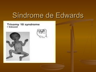Síndrome de Edwards

 