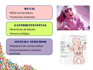 RENAL
•Riñón en herradura
•Trastornos ureterales
GASTROINTESTINAL
•Divertículo de Meckel
•Atresia esofágica
SISTEMA NERVIOSO
•Hipoplasia de cuerpo calloso
•Circunvoluciones centrales
anómalas
 