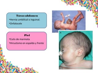 Tórax-abdomen
•Hernia umbilical o inguinal.
•Onfalocele
Piel
•Cutis de marmota
•Hirsutismo en espalda y frente
 