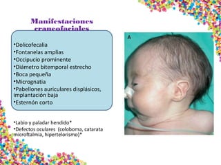 Manifestaciones
craneofaciales
•Dolicofecalia
•Fontanelas amplias
•Occipucio prominente
•Diámetro bitemporal estrecho
•Boca pequeña
•Micrognatia
•Pabellones auriculares displásicos,
implantación baja
•Esternón corto
•Labio y paladar hendido*
•Defectos oculares (coloboma, catarata
microftalmia, hipertelorismo)*
 