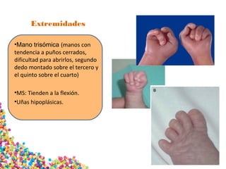 Extremidades
•Mano trisómica (manos con
tendencia a puños cerrados,
dificultad para abrirlos, segundo
dedo montado sobre el tercero y
el quinto sobre el cuarto)
•MS: Tienden a la flexión.
•Uñas hipoplásicas.
 