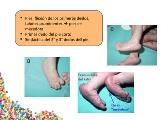  Pies: flexión de los primeros dedos,
talones prominentes  pies en
mecedora
 Primer dedo del pie corto
 Sindactilia del 2° y 3° dedos del pie.
 