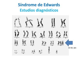 Síndrome de Edwards
Estudios diagnósticos
47 XY, 18+
 