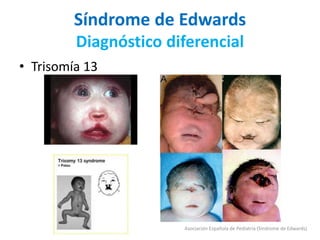 Síndrome de Edwards
Diagnóstico diferencial
• Trisomía 13
Asociación Española de Pediatría (Síndrome de Edwards)
 