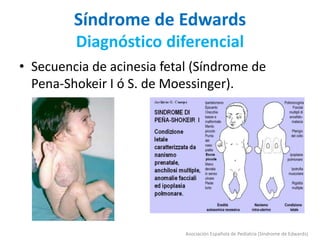 Síndrome de Edwards
Diagnóstico diferencial
• Secuencia de acinesia fetal (Síndrome de
Pena-Shokeir I ó S. de Moessinger).
Asociación Española de Pediatría (Síndrome de Edwards)
 