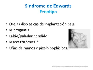 Síndrome de Edwards
Fenotipo
• Orejas displásicas de implantación baja
• Micrognatia
• Labio/paladar hendido
• Mano trisómica *
• Uñas de manos y pies hipoplásicas.
Asociación Española de Pediatría (Síndrome de Edwards)
 