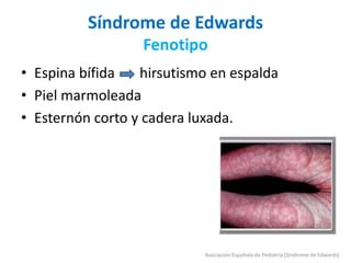 Síndrome de Edwards
Fenotipo
• Espina bífida hirsutismo en espalda
• Piel marmoleada
• Esternón corto y cadera luxada.
Asociación Española de Pediatría (Síndrome de Edwards)
 