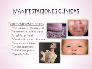 *ASPECTOS DERMATOLÓGICOS 
*Piel lisa, suave y aterciopelada 
*Hiperextensibilidad de la piel 
*Fragilidad en la piel 
*Cicatrización lenta y dificultosa 
*Lesiones secundarias 
*Arrugas epicánticas 
*Pápulas piezogénicas 
*Signo de Gorlin 
 