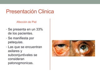 Presentación Clinica 
Afección de Piel 
• Se presenta en un 33% 
de los pacientes. 
• Se manifiesta por 
petequias. 
• Las que se encuentran 
axilares y 
subconjuntivales se 
consideran 
patonogmonicas. 
 
