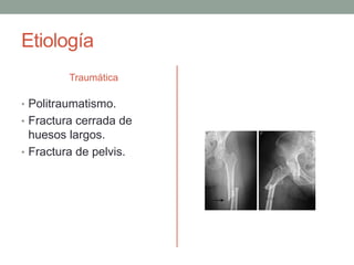 Etiología 
Traumática 
• Politraumatismo. 
• Fractura cerrada de 
huesos largos. 
• Fractura de pelvis. 
 