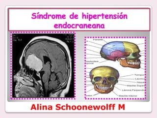 Síndrome de hipertensión
      endocraneana




Alina Schoonewolff M
 