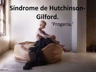 Síndrome de Hutchinson-Gilford. ‘ Progeria.’ 