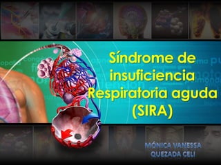 Síndrome de
insuficiencia
Respiratoria aguda
(SIRA)
 