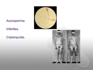 Azoospermia.
Infértiles.
Criptorquídia.
 