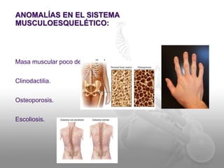 ANOMALÍAS EN EL SISTEMA 
MUSCULOESQUELÉTICO: 
Masa muscular poco desarrollada. 
Clinodactilia. 
Osteoporosis. 
Escoliosis. 
 