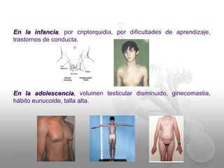 En la infancia, por criptorquidia, por dificultades de aprendizaje, 
trastornos de conducta. 
En la adolescencia, volumen testicular disminuido, ginecomastia, 
hábito eunucoide, talla alta. 
 