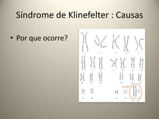 Síndrome de Klinefelter : Causas
• Por que ocorre?
 