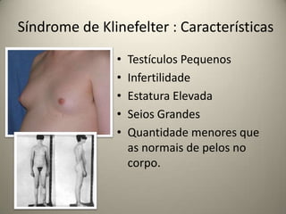 Síndrome de Klinefelter : Características
• Testículos Pequenos
• Infertilidade
• Estatura Elevada
• Seios Grandes
• Quantidade menores que
as normais de pelos no
corpo.
 