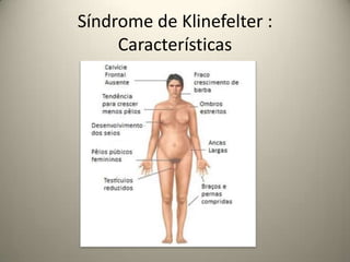 Síndrome de Klinefelter :
Características
 