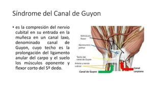 Síndrome del Canal de Guyon
• es la compresión del nervio
cubital en su entrada en la
muñeca en un canal laxo,
denominado canal de
Guyon, cuyo techo es la
prolongación del ligamento
anular del carpo y el suelo
los músculos oponente y
flexor corto del 5º dedo.
 