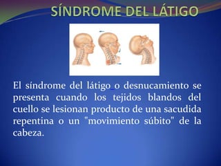 El síndrome del látigo o desnucamiento se
presenta cuando los tejidos blandos del
cuello se lesionan producto de una sacudida
repentina o un "movimiento súbito" de la
cabeza.
 