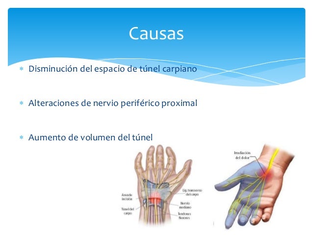 Sindrome De Tunel Del Carpo Gpc